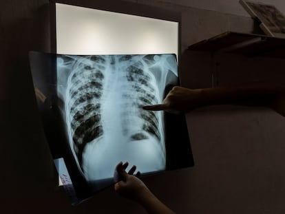 Mariela, especialista en enfermedades infecciosas, examina la radiografía de Jorge, un paciente de 24 años en tratamiento contra la tuberculosis, en Buenos Aires, Argentina.