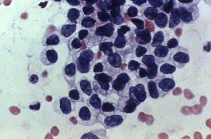 Células de un adenocarcinoma vaginal.