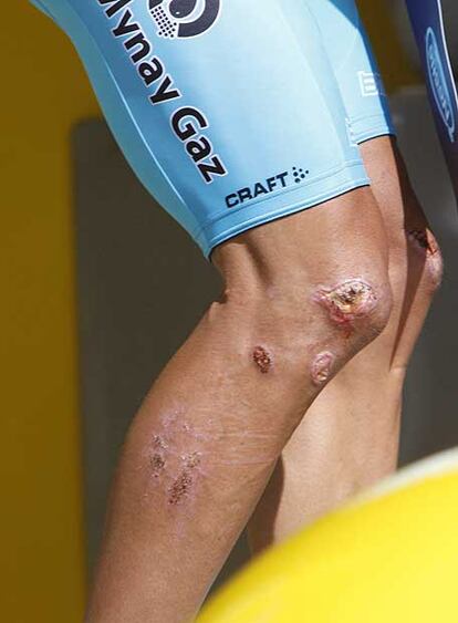 Imagen de las rodillas de Vinokúrov tras la etapa de ayer.
