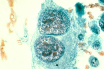 Células de un osteosarcoma maligno humano (cáncer de hueso), de un tumor en una pierna.