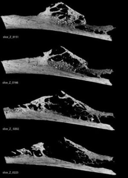 El deterioro del interior de la Costilla de neandertal (120.000 años) debido a un tumor benigno se aprecia en esta secuencia de microescáner del hueso.