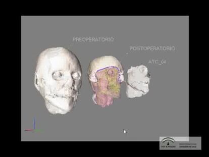 Reconstrucción computerizada del trasplante de estructura facial (I)
