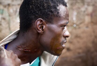Un hombre muestra una herida causada por los enfrentamientos con la policía en Kibera, Nairobi.