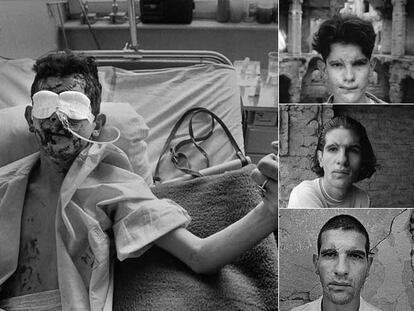 El bosnio Adis Smajic, dos días después de su accidente en 1996