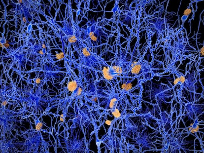 Ilustración por ordenador de placas amiloides entre neuronas.