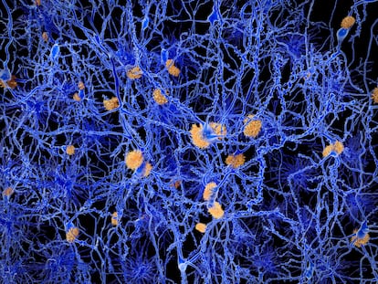 Ilustración por ordenador de placas amiloides entre neuronas.