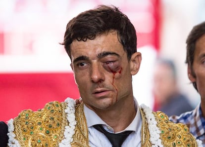 Paco Ureña con la herida en el ojo izquierdo.