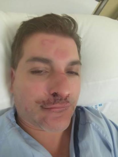 'Selfie' de César Román en un hospital madrileño, donde fue ingresado tras recibir una paliza.