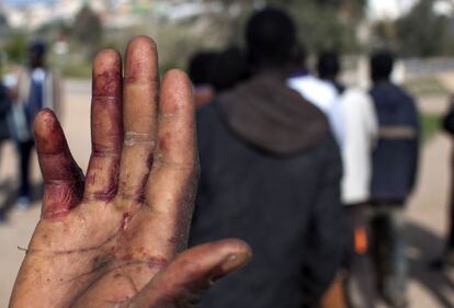 As mãos machucadas de um imigrante que conseguiu pular a cerca fronteiriça de Melilla, território espanhol, em 18 de março de 2014.