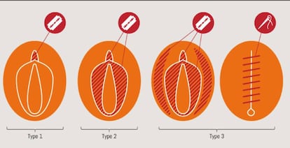 Tipos de Mutilación Genital Femenina.