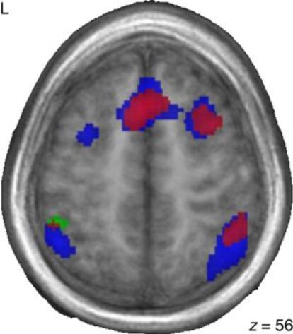 Áreas cerebrales que se activan durante las tareas de francés para niños bilingües (en rojo), niños chinos adoptados en Francia (en azul) y niños franceses (en verde).