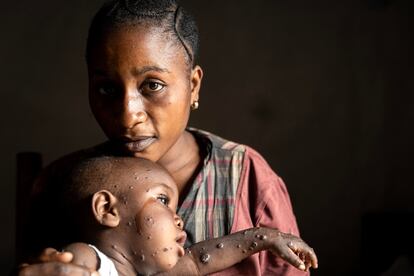 Francoise Bulangalire, de 19 años, sostenía el martes en brazos a su hijo Michael Ombeni, de 12 meses, que está recibiendo tratamiento contra la mpox en el hospital Kavumu de Karanrhada, en la provincia de Kivu del Sur, en República Democrática del Congo. La esperanza por frenar el brote de la enfermedad, conocida como viruela del mono, crece tras la llegada del primer cargamento de vacunas al país, previsto este fin de semana, tal y como lo anunció este miércoles el director general de la Organización Mundial de la Salud (OMS), Tedros Adhanom Ghebreyesus, en una rueda de prensa.  La mpox causa fiebre, erupciones y lesiones por todo el cuerpo, fuertes dolores de cabeza y fatiga.
