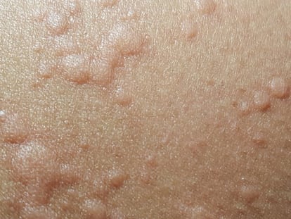 Hives, which are a possible symptom of the coronavirus.