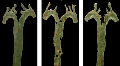 Aortenarterien einer gesunden Maus (links), einer anderen, die Imidazolpropionat ausgesetzt war (Mitte), und einer weiteren, die mit Propionat und einem Inhibitormedikament behandelt wurde, mit roter Färbung der atherosklerotischen Plaque.