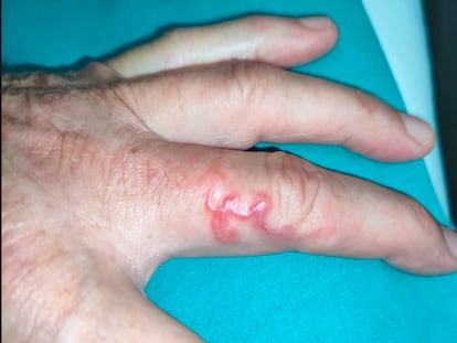 One of Spain’s latest cases of cutaneous larva migrans, a 75-year-old patient from Cantabria who contracted the disease while working in an orchard.
