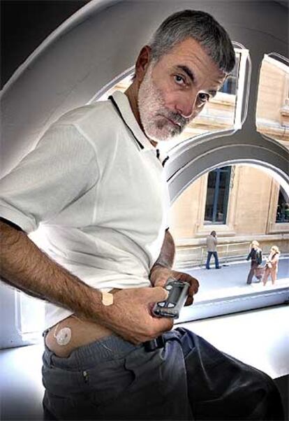 El paciente Antonio Tosco, con su nueva bomba de insulina.