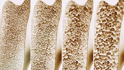 La cuatro etapas de la osteoporosis.