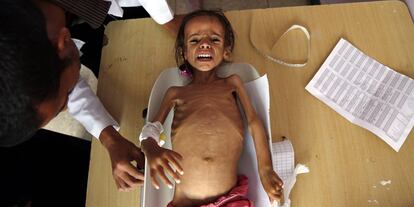 una niña desnutrida se pesa en un hospital en Sana'a (Yemen).