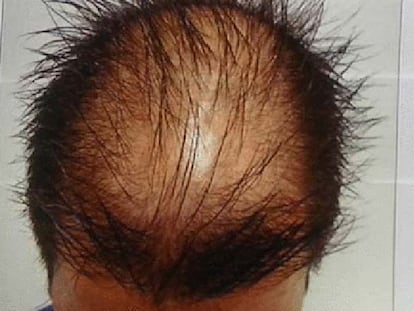 Posible solución al problema de la calvicie humana