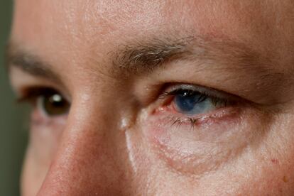 Phil Durst, who has undergone an experimental stem cell procedure with his eyes, sits for a portrait in Homewood, Ala., on Aug. 15, 2023.