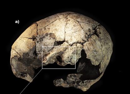 Cráneo trepanado de la mujer hallada en Reinoso (Burgos).