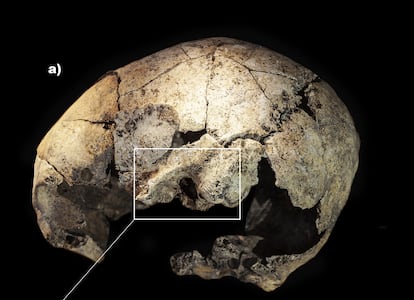 The trepanned skull of the woman found in Reinoso (Burgos).