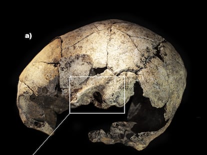 Cráneo trepanado de la mujer hallada en Reinoso (Burgos).