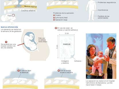 Así se opera una espina bífida