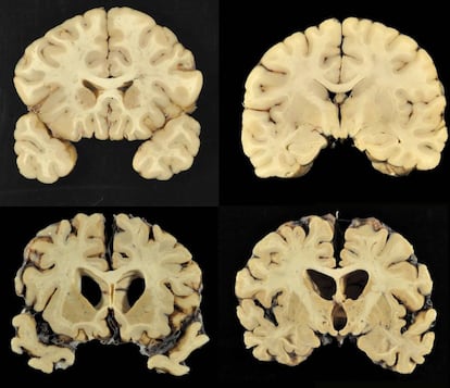 Un cerebro normal, arriba, y uno con CTE nivel 4, en una imagen del estudio.