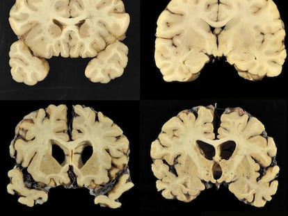 Un cerebro normal, arriba, y uno con CTE nivel 4, en una imagen del estudio.