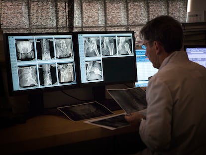 Un radiólogo observa una radiografía de cadera.