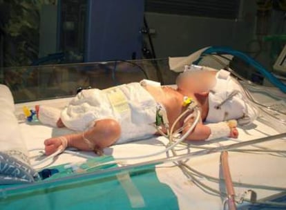 Paola, en la incubadora, tras ser operada.