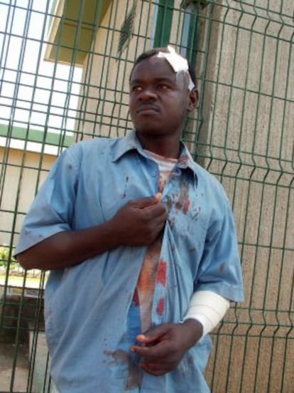 A sub-Saharan immigrant injured by razor wire in 2005 in Melilla.