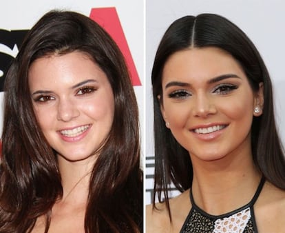 Hace un par de años, Kendall Jenner, la hermana menor de Kim Kardashian, aún no se había planteado retocarse la nariz. Ahora, con solo 20 años, toda su cara tiene unos rasgos mucho más finos. Según varios medios internacionales, la musa de Balmain se realizó una rinoplastia poco antes de su primer debut en la Semana de la Moda de Nueva York, en 2014.