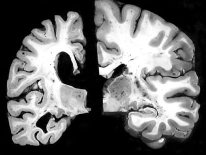 Comparaci&oacute;n del cerebro de una persona con alzh&eacute;imer, a la izquierda, y otra sana
