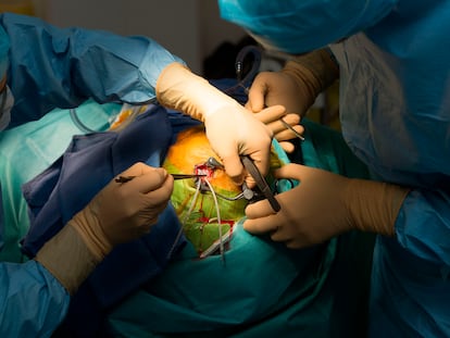 Image of the surgery required for deep brain stimulation.