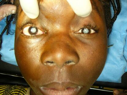 Una joven operada que ha recuperado su visi&oacute;n tras ser intervenida oftalm&oacute;logos espa&ntilde;oles. 