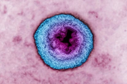 <p>Enfermedad causada por el virus del herpes simple, que cuando contagia permanece en el cuerpo para siempre, es decir, <strong>no tiene cura</strong>. En general se manifiesta con brotes de llagas o ampollas en el área genital pero con el tiempo estos brotes se van espaciando y pasan largas fases latentes (de años). Pero ojo, su contagio también se puede producir en una fase latente. Al igual que eón las demás ETS, es necesario avisar a las parejas sexuales para que puedan tratarse y prevenir su propagación.</p> <p><strong>Síntomas (ambos sexos):</strong> se manifiesta con brotes de llagas o ampollas en el área genital que con el tiempo se van espaciando y pasa a largas fases latentes (de años) en las que también se puede contagiar.</p> <p>Lo que puede ser una temporada de apuro con una llaga incómoda en un hombre, en una mujer puede tener consecuencias más complicadas. Si está embarazada durante el contagio se puede producir un aborto espontáneo o un parto prematuro. Además, el virus podría transmitirse al bebé durante el parto provocándole daños de diversa consideración. En este sentido <a href="martasuarezginecologa.blogspot.com" rel="nofollow" target="_blank">Marta Suárez</a> especialista en ginecología y obstetricia, recomienda "realizar un chequeo completo de ETS previo al embarazo, tanto para ella como para su pareja". </p> <p><strong>Tratamiento:</strong> no existe un tratamiento específico, se tratan los síntomas.</p>