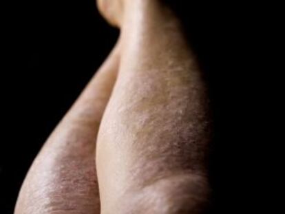 Lesiones de psoriasis.