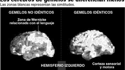 Cerebros de gemelos