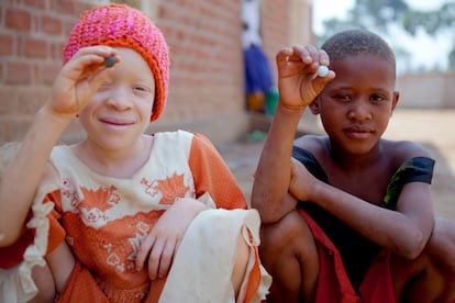 <span >Albinismo: conjunto de condiciones heredadas que se identifican en la persona por la falta de coloración en el pelo, piel y ojos, producto de la herencia de un gen con defecto en la producción de melanina. Y, cuando deberías ser negra, no veas lo que se nota.</span>