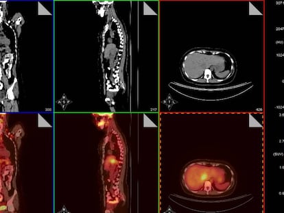 A crise que ameaça parar exames para câncer em várias partes do Brasil