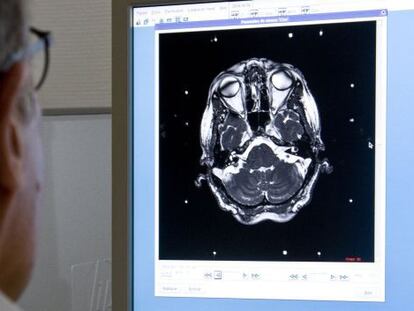 Un médico revisa una prueba diagnóstica del cerebro de un paciente.