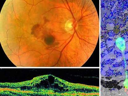 Arriba, fondo de ojo con degeneración macular (en el centro) y perfil en el que las zonas oscuras representan fotorreceptores perdidos. A la derecha, bastón implantado (fluorescente) conectado a la retina.