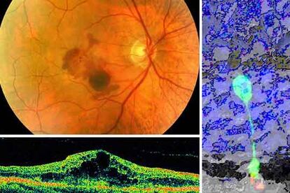 Arriba, fondo de ojo con degeneración macular (en el centro) y perfil en el que las zonas oscuras representan fotorreceptores perdidos. A la derecha, bastón implantado (fluorescente) conectado a la retina.