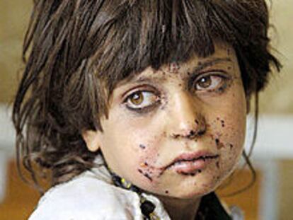 Una niña con heridas de metralla en la cara, en un hospital de Quetta.