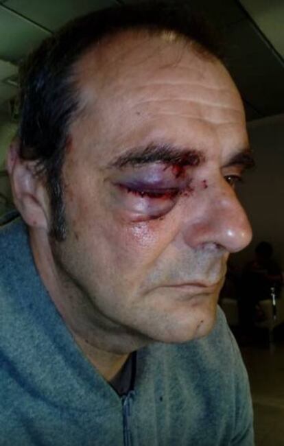 Sindicalista de Acaip herido en un ojo durante la protesta.