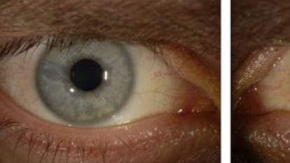 Antes de contraer el ébola, los ojos de Crozier eran azules. Después de haberse recuperado de la enfermedad, su ojo izquierdo se volvió verde.