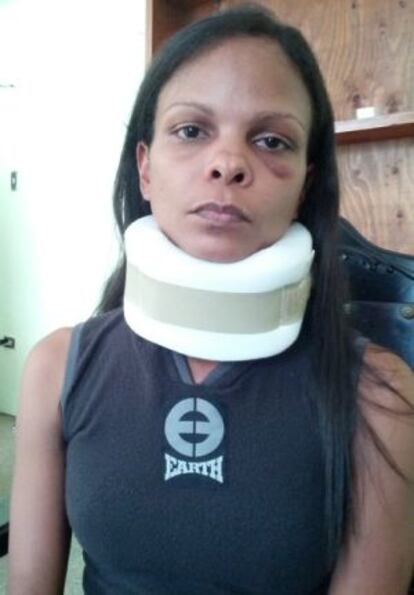 Marvinia Jímenez fue víctima de una paliza por la Guardia del Pueblo el 24 de febrero de 2014 cuando sacaba fotos de una manifestación en Valencia, Estado de Carabobo (Venezuela).