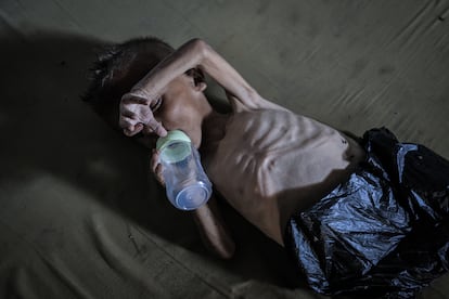 Muhamad Zakariya Ayoub al-Matouq, de apenas año y medio, sufre desnutrición severa y potencialmente mortal. Su peso ha caído de 9 a 6 kilos, y lucha por sobrevivir en una tienda de campaña donde escasean la leche, los alimentos y otros productos básicos. Fotografía tomada el pasado 21 de julio de 2025.